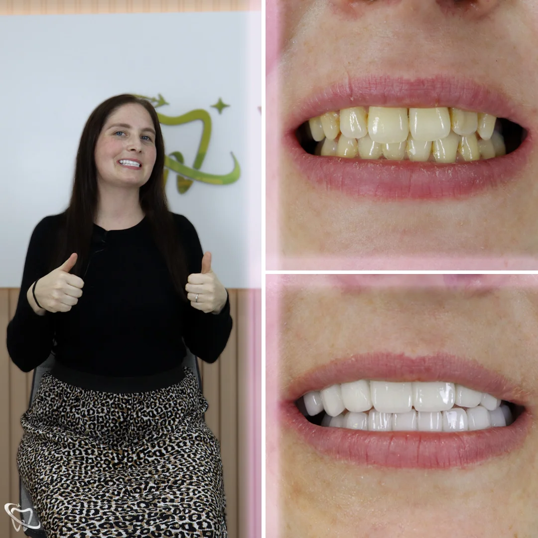 Emma before after