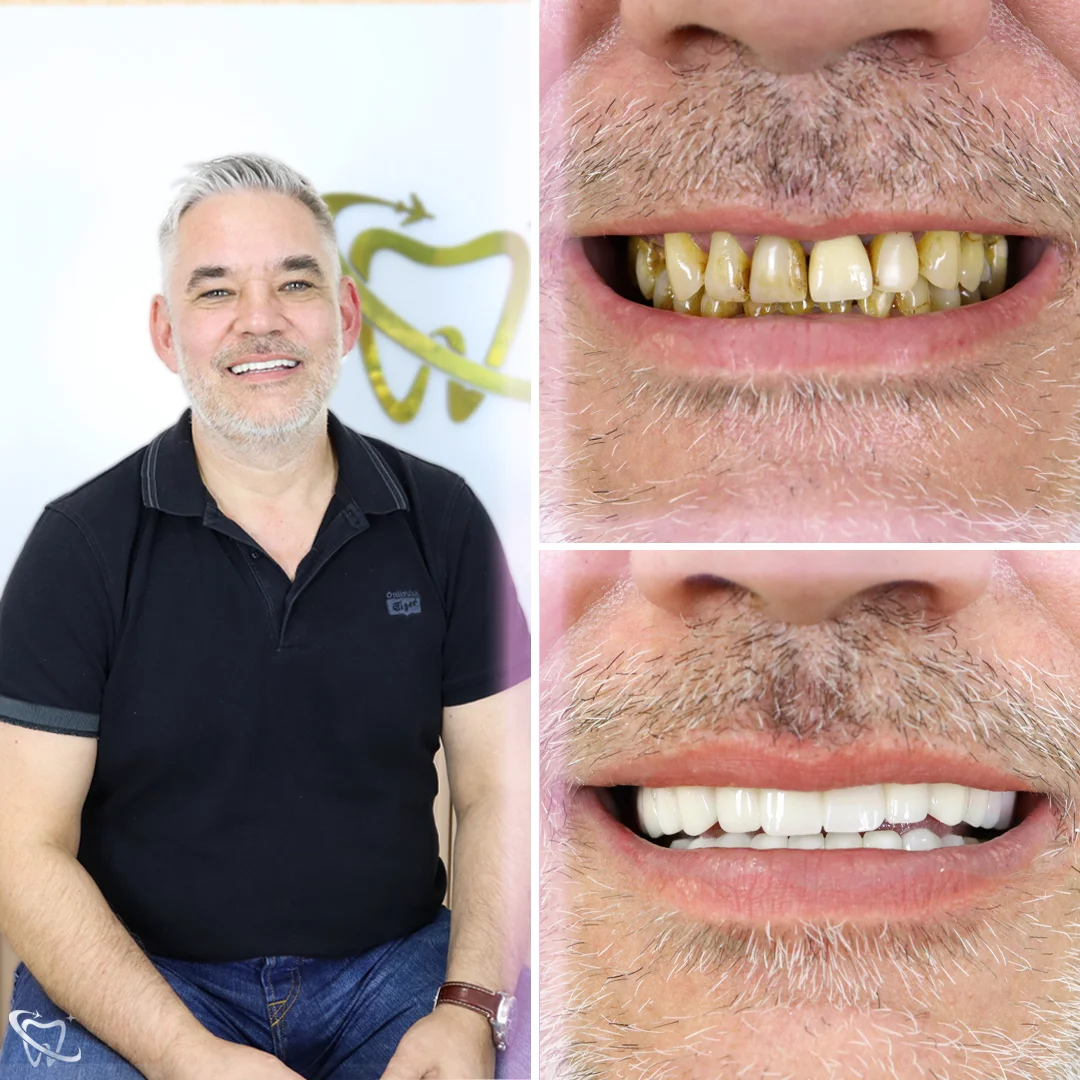 Tomasz before after (1)