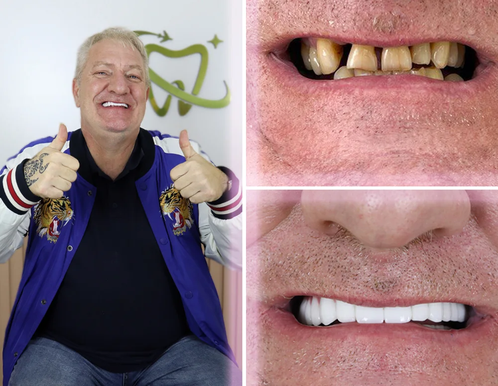 https://dinamik.yoursmileturkey.com/wp-content/uploads/2023/03/all-on-6-implants-before-after.webp