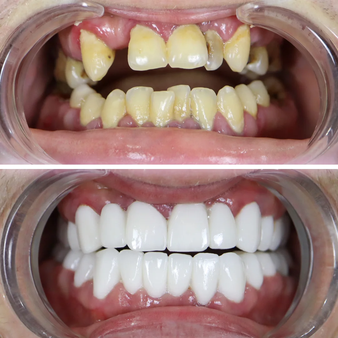 before-after-your-smile-turkey