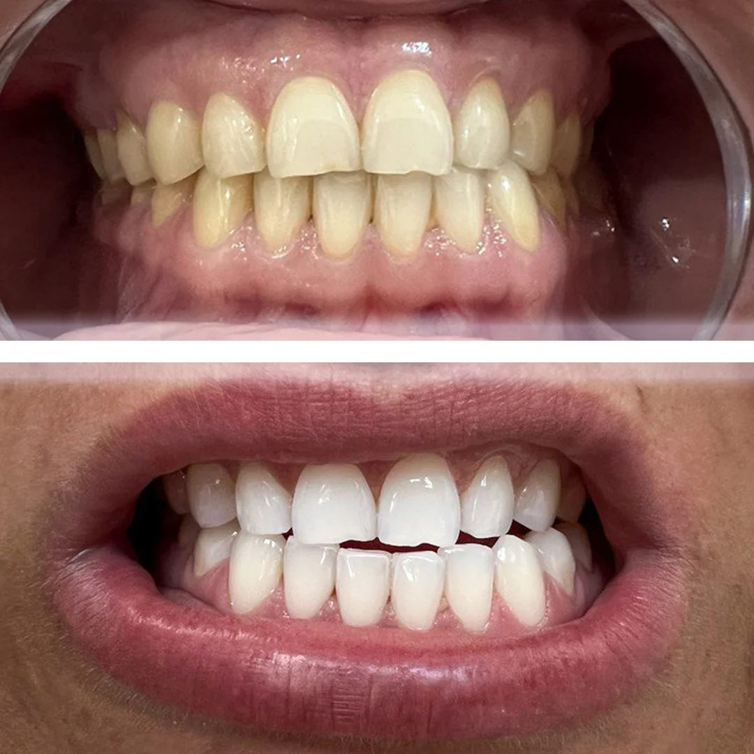 bleaching-2