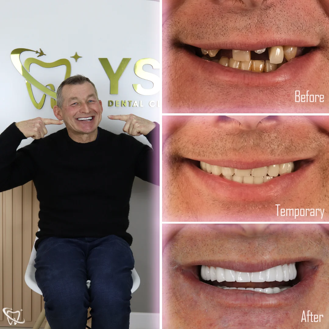 dental-all-on-four-treatment-antalya
