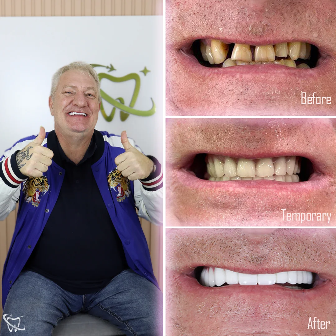 dental-all-on-six-treatment