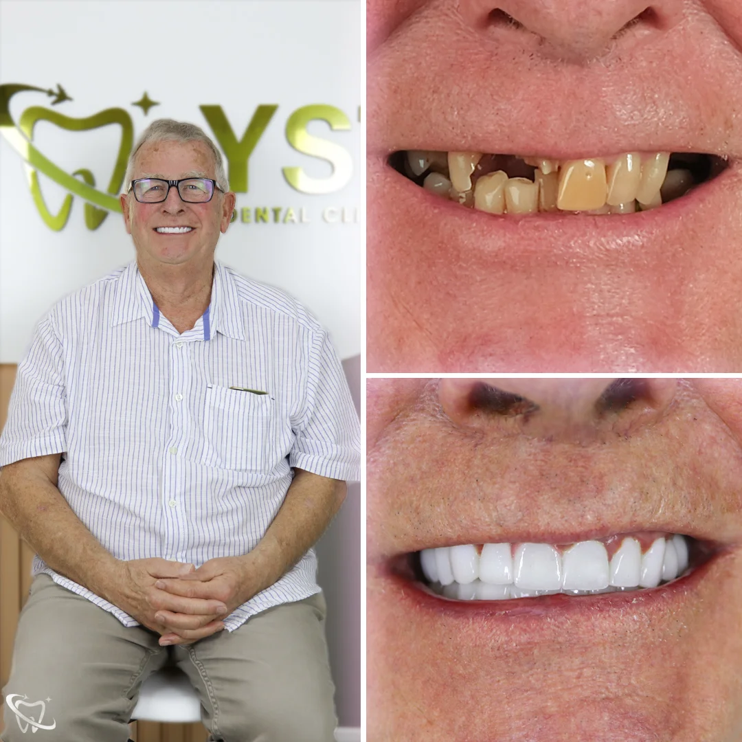 dental-implant-antalya