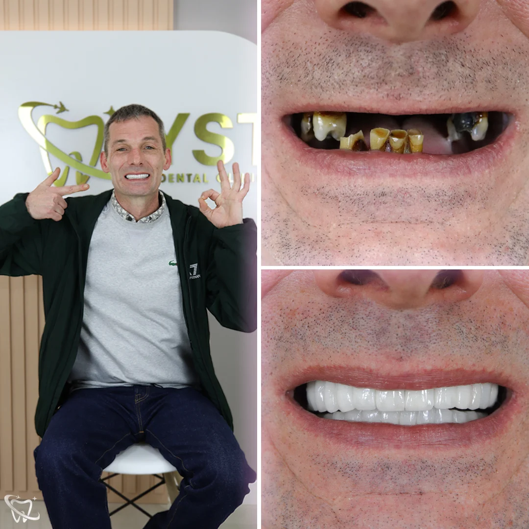 dental-implant-your-smile-turkey