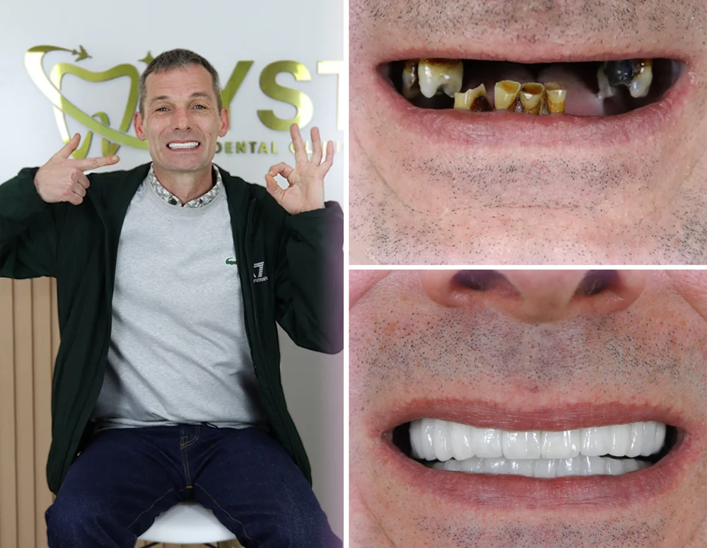 https://dinamik.yoursmileturkey.com/wp-content/uploads/2023/03/dental-implants-before-after.webp