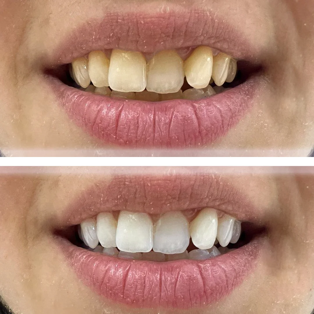 dental-laser-teeth-whitening