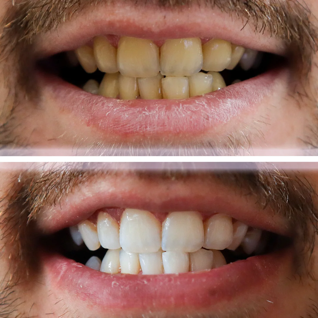 dental-teeth-whitening-turkey