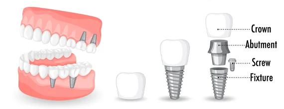 dental-implant-prices-turkey