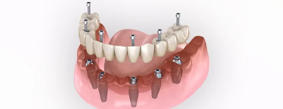 dental treatment packages