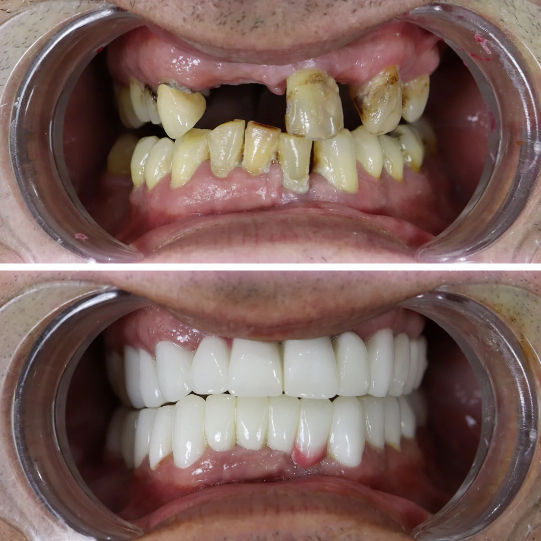 smile-makeover-your-smile-turkey