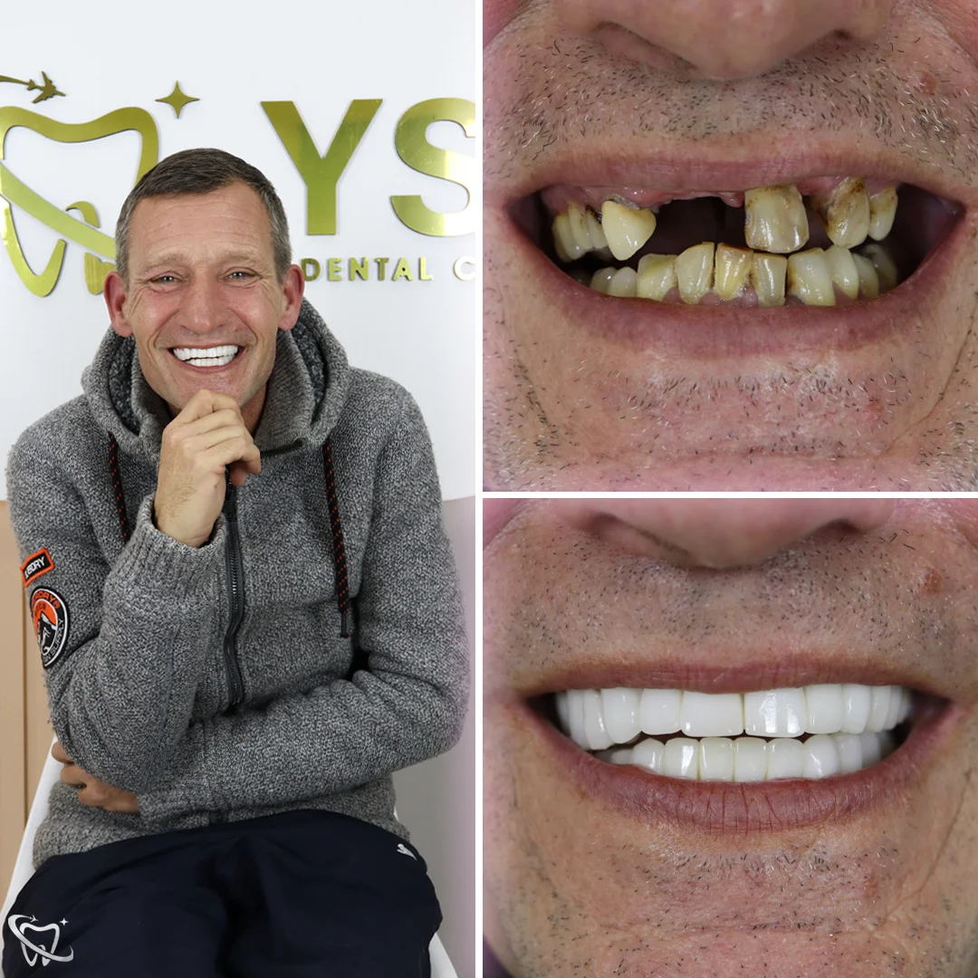 smile-zirconia-turkey