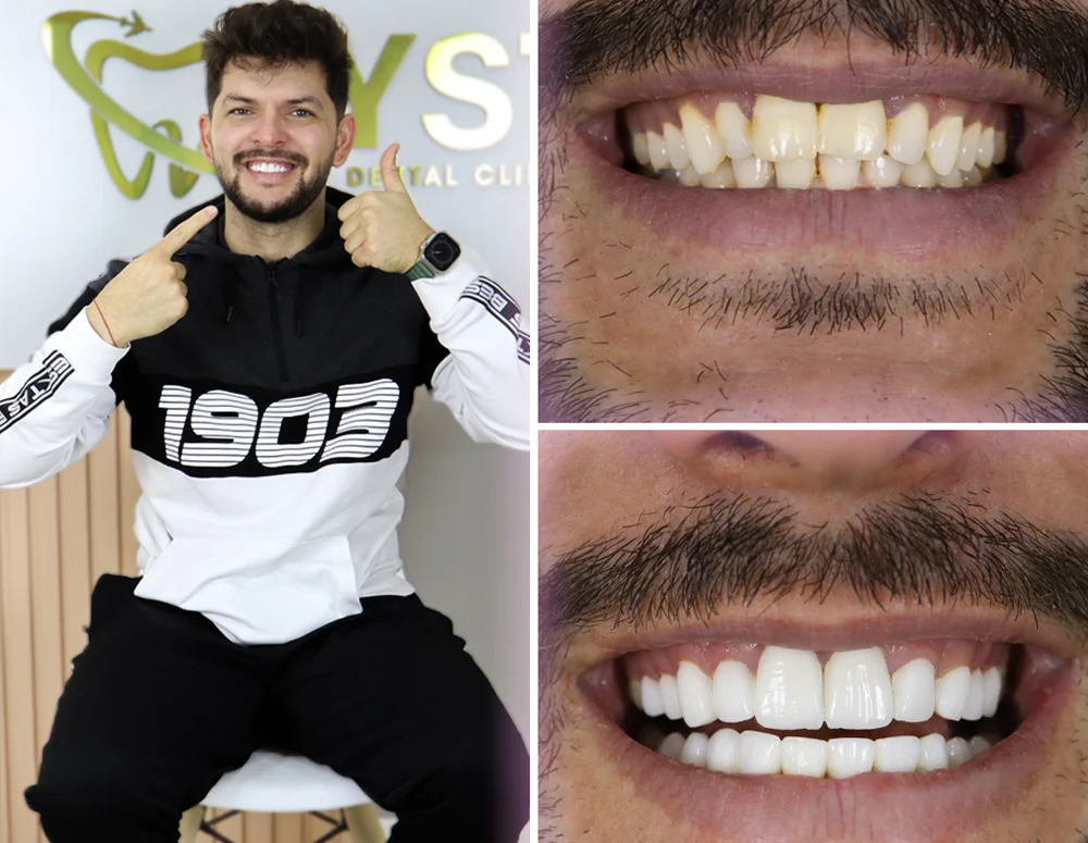 https://dinamik.yoursmileturkey.com/wp-content/uploads/2023/03/smiledesign-before-after.webp
