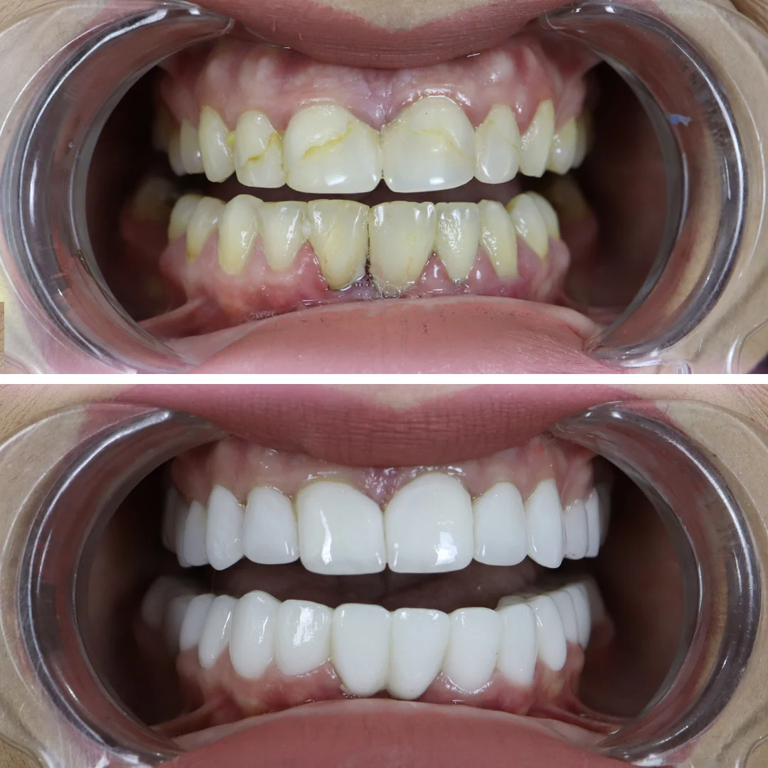 your-smile-turkey-before-after