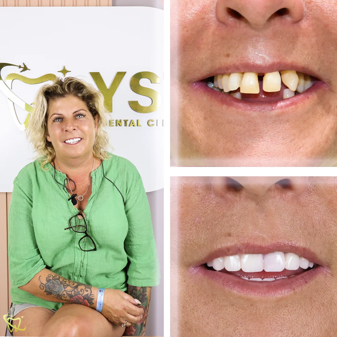 your-smile-turkey-dental-clinic-antalya