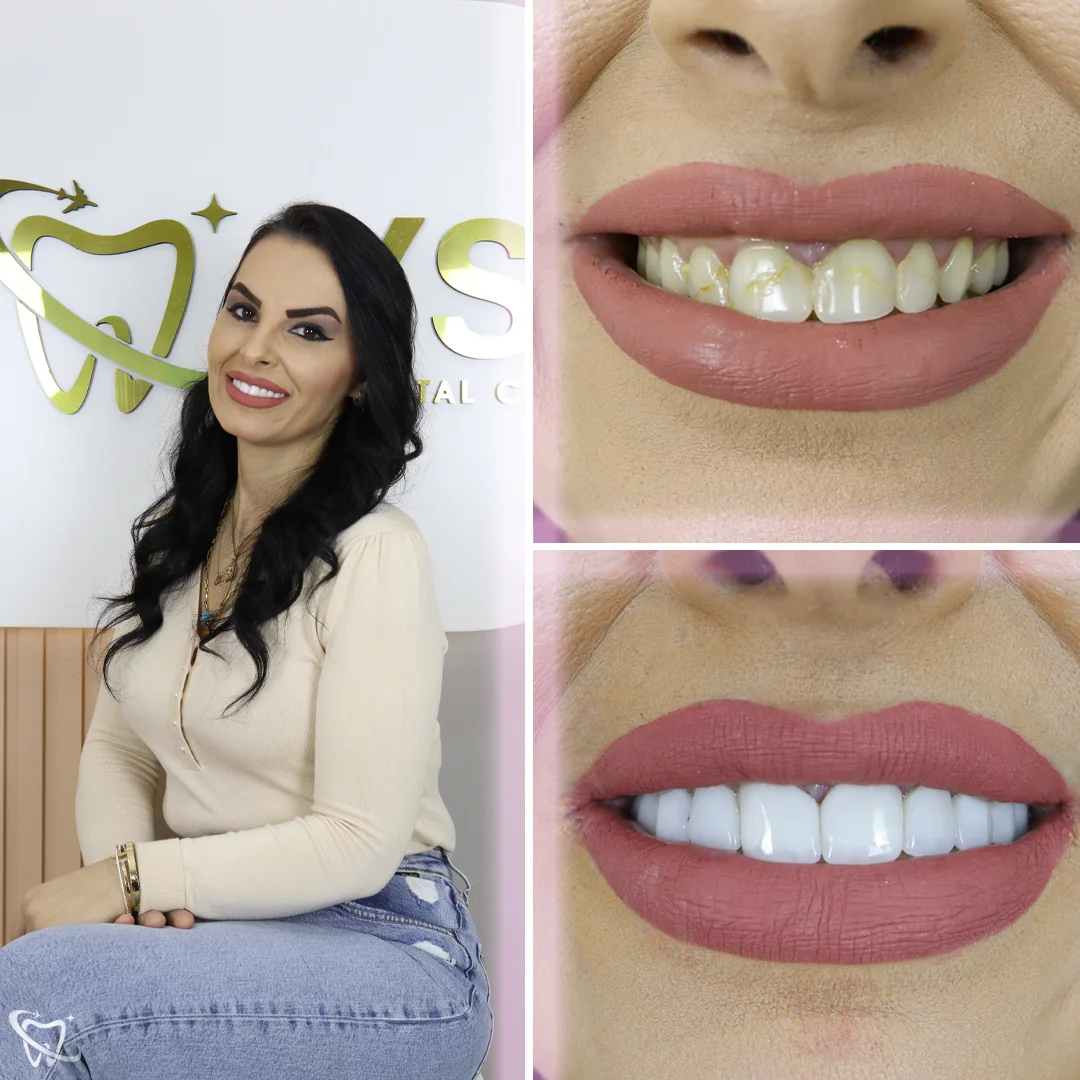 your-smile-turkey-dental-clinic-zirconium-crown