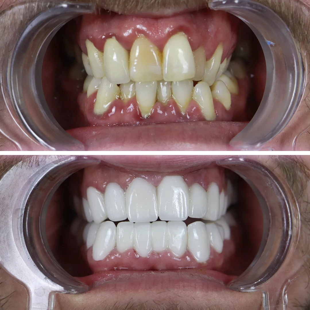 zirconium-crown-antalya